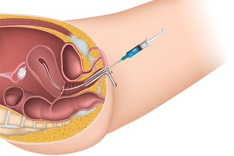 Surgery- maa fartility